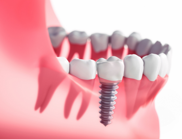 Kalispell_dental_implants_dentist