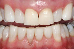 un parallel teeth