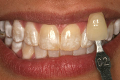 upper teeth upper teeth