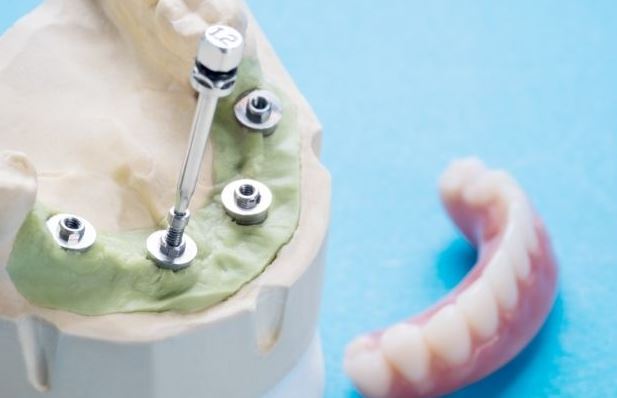 dental_implants_Kalispell_dentist