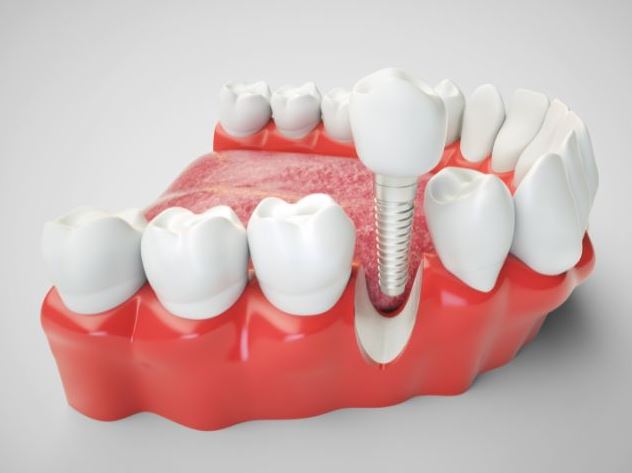 dental_implants_Kalispell_dentist