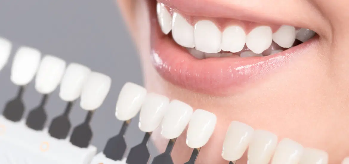 professional_teeth_whitening_Kalispell_dentist